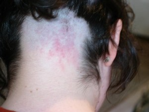 Large reddish-pink splotchy rash on the back of Shaved head