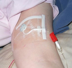 Closeup of Sharons arm with PICC line coming out of biceps